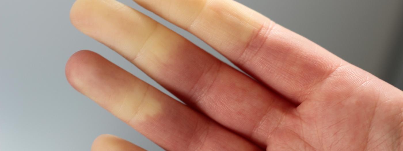 Raynaudův fenomén: Když prsty zbělají chladem