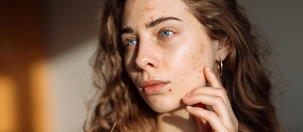 Akné u teenagerů