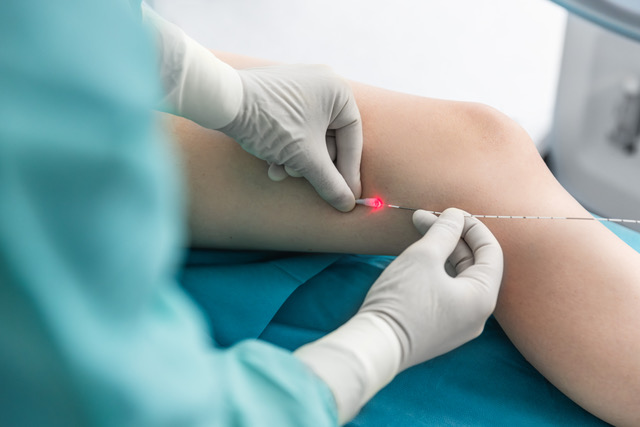 laserova operace křečových žil