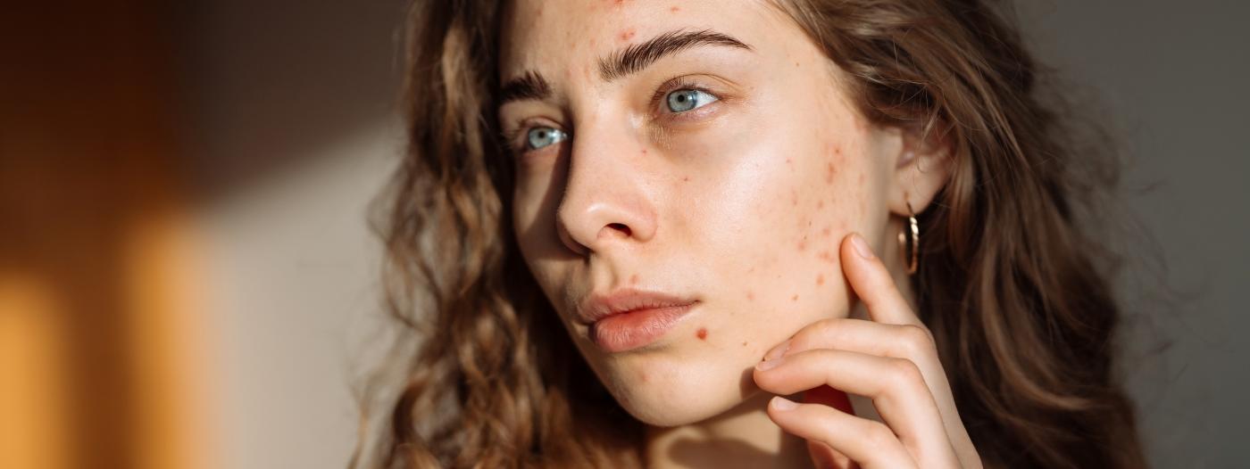 Akné u teenagerů