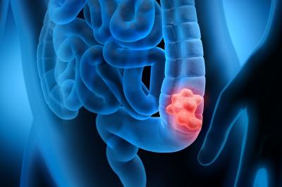 kolorektální karcinom