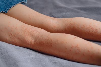 Porfyrie – nemoci krve