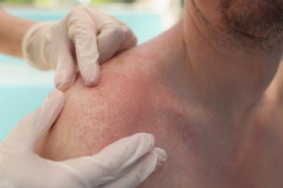 Jak vypadá sluneční alergie? 