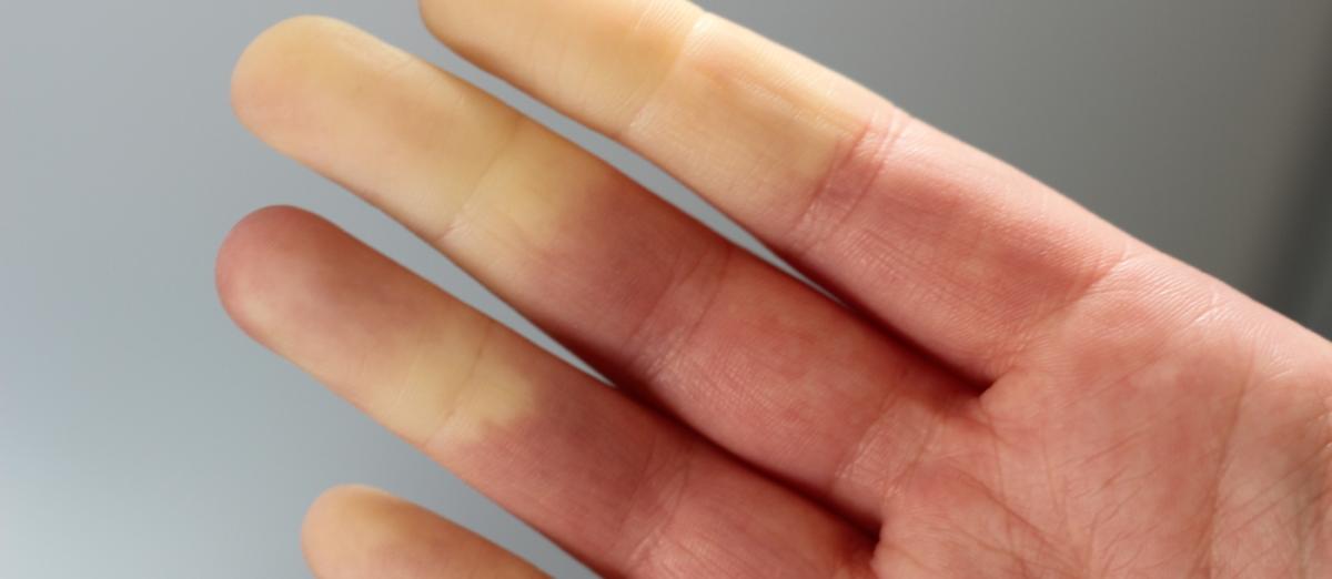 Raynaudův fenomén: Když prsty zbělají chladem